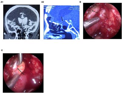 Intraoperative Injection of Normal Saline Through Lumbar Drainage for Transnasal Endoscopic Repair of Complex CSF Leaks